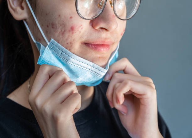 primo piano della giovane donna asiatica apre la sua maschera e mostra problemi di acne si verificano sulla sua pelle a causa di indossare la maschera per lungo tempo. - longtime foto e immagini stock