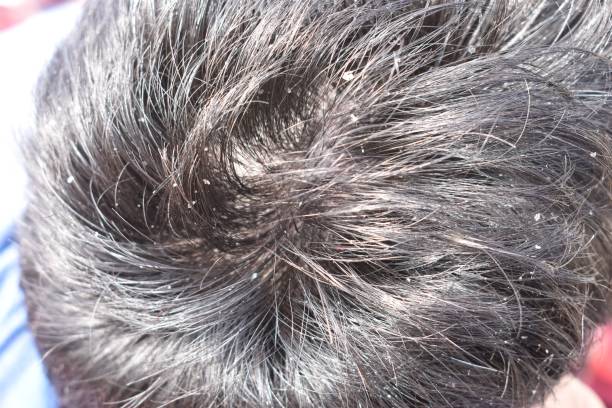 Men's hair is a top view close-up with Gray hair and Dandruff Men's hair is a top view close-up with Gray hair and Dandruff dandruff stock pictures, royalty-free photos & images