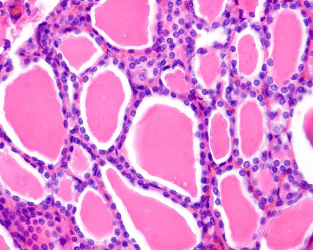 istock Human thyroid gland. Follicular adenoma 1368498251