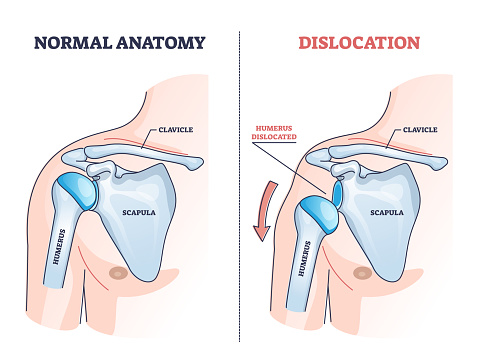 Shoulder dislocation and humerus bone trauma explanation outline diagram. Labeled educational medical injury when skeletal part rotates out of scapula vector illustration. Painful arm vs healthy.
