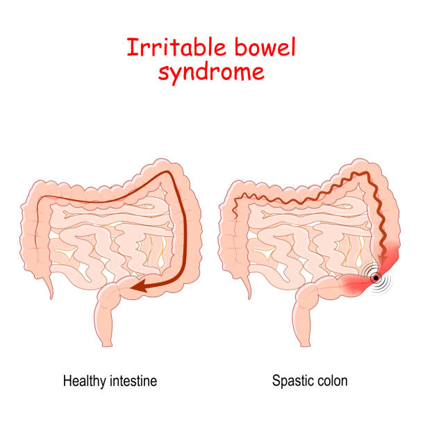 illustrations, cliparts, dessins animés et icônes de syndrome du côlon irritable - infection du tube intestinal