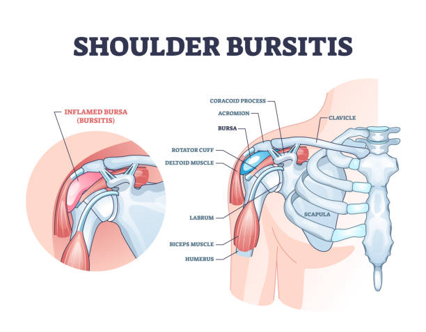 ilustraciones, imágenes clip art, dibujos animados e iconos de stock de bursitis del hombro como inflamación de la bolsa dolorosa médica diagrama de contorno - rotator cuff