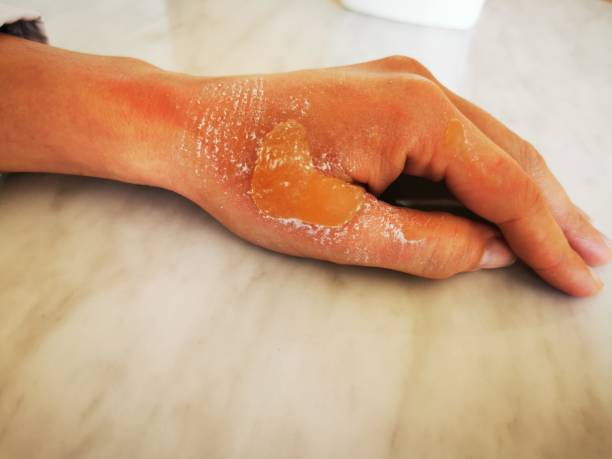 mano e pollice del paziente con vesciche di calore e lesioni. vesciche su parti del corpo. - second skin foto e immagini stock