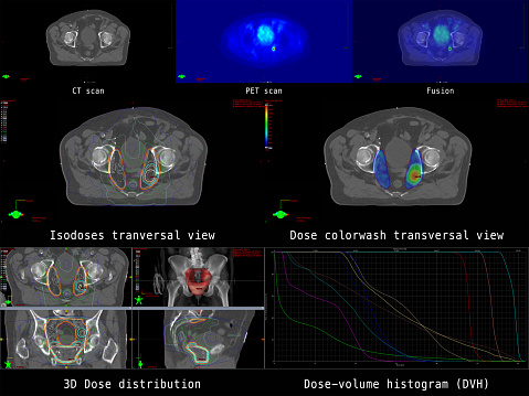 Ilustración de la planificación moderna de la radiación para la terapia del cáncer en el cáncer de próstata con afectación de los ganglios linfáticos pélvicos. photo