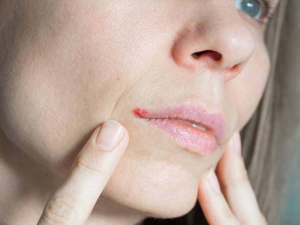 istock Close up woman's face with a virus herpes on lips. Herpes treatment concept. Recovery from illness in the spring. 1368746151