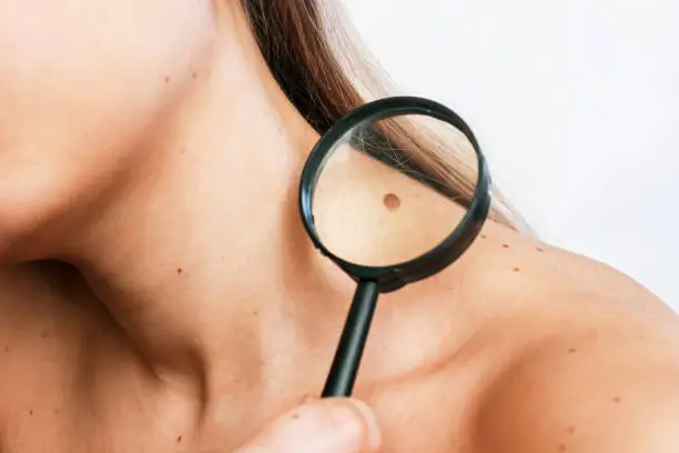 Close-up of a big mole on a young woman's neck magnified with a magnifying glass isolated on a gray background. The effect of sunlight on the skin