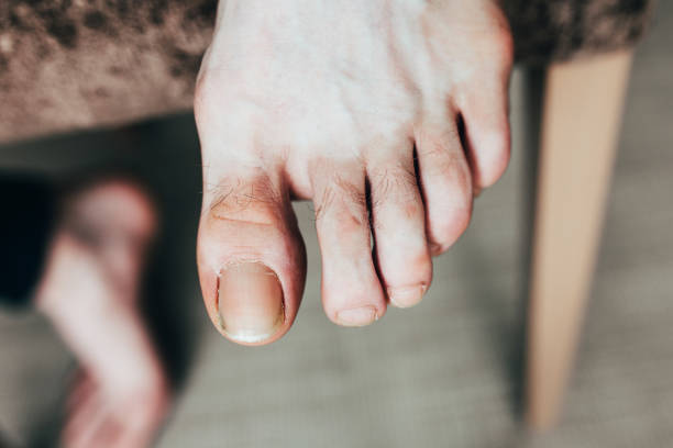 istock Men foot pedicure before nail treatment - cracked thumbnail 1368915432