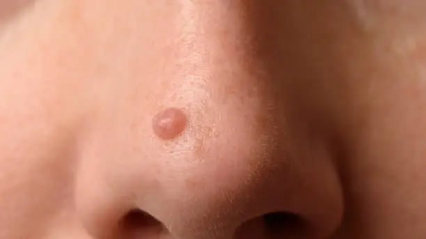 Mole or nevus on the nose on woman's face. Closeup
