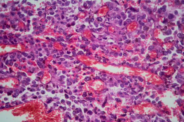 Lung tissue adenocarcinoma with HE stain as seen under a microscope. Magnified sample of lung tissue displaying adenocarcinoma (cancer) adenocarcinoma photos stock pictures, royalty-free photos & images