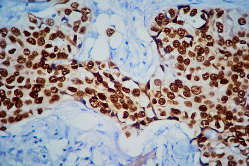 Breast tissue adenocarcinoma immunohistochemistry. Estrogen receptors.