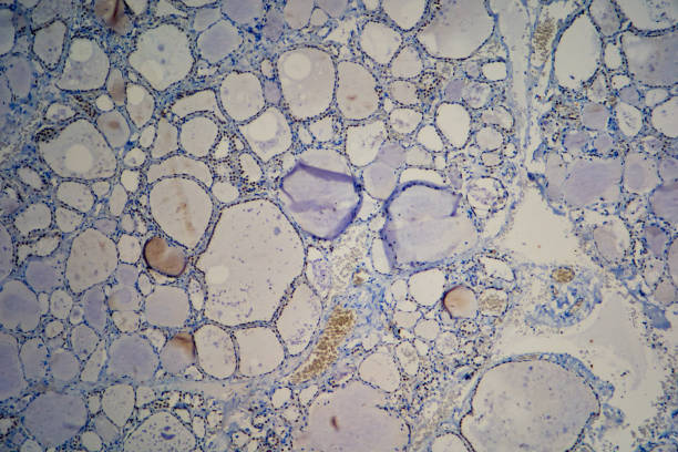 Immunohistochemistry TTF1 of the Thyroid. TTF1 Control. Thyroid sample, nuclear testing. adenocarcinoma photos stock pictures, royalty-free photos & images