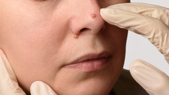 Diagnosis of skin mole or nevus on woman's face. Doctor's hands in surgical gloves examining nevi on nose. Checking moles concept. Closeup