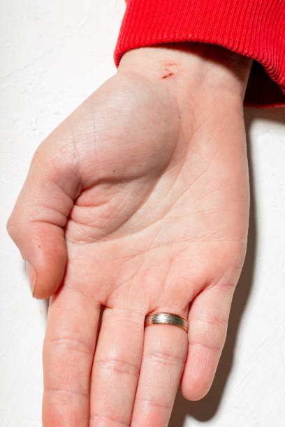 istock A woman's hand with a small scratch. Woman's hand with a wedding ring. White background. 1369176645