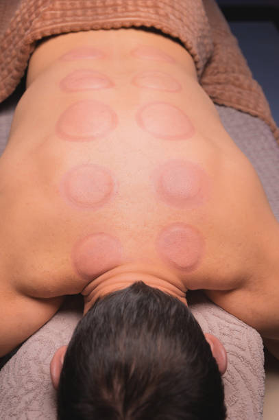 mann nach schröpftherapie auf dem rücken. haut nach schröpfen in der traditionellen chinesischen medizin. der mann kehrte von hijama-tassen in der akupunkturtherapie zurück. traditionelle chinesische behandlung. - alternative medicine massaging spa treatment back stock-fotos und bilder