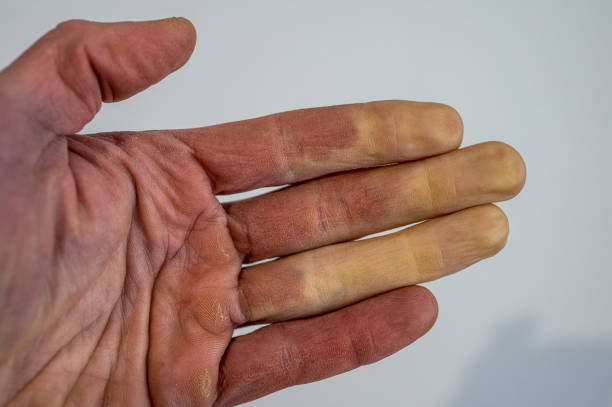 una mano masculina congelada con síndrome de raynaud, fenómeno de raynaud o enfermedad de raynaud. - discolored fotografías e imágenes de stock
