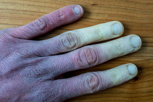 uma mão masculina gelada com síndrome de raynaud, o fenômeno de raynaud ou a doença de raynaud. - discolored - fotografias e filmes do acervo