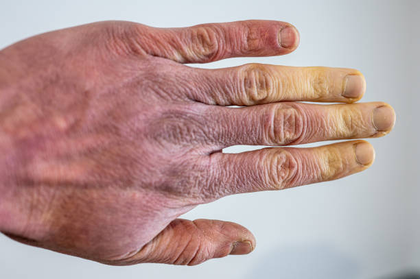 a frostbitten male hand with raynaud's syndrome, raynaud's phenomenon or raynaud's disease. - congelação imagens e fotografias de stock