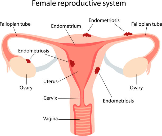 istock Endometriosis, schematic illustration of the female reproductive system diseases 1369362449