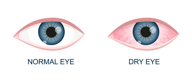 ilustrações de stock, clip art, desenhos animados e ícones de human eye healthy and dry. normal and inflamed bloodshot eyeball with irritation and red conjunctiva. symptoms of keratitis, allergy, conjunctivitis, uveitis. vector cartoon illustration - áspero