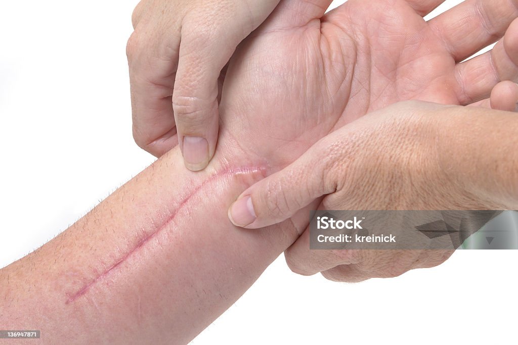 Therapist performing a hand massage patient getting a therapy massage on scar Scar Stock Photo