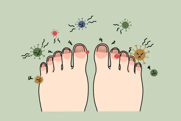 Vector illustration of Unhealthy foot with nail infection or virus