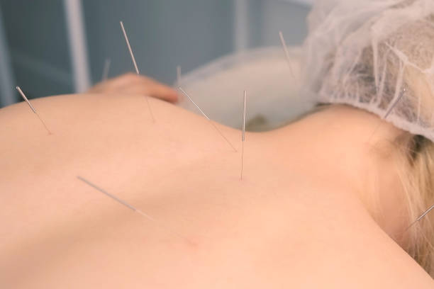 istock Acupuncture treatment with needles inserted to woman's back and neck, closeup. 1369573431