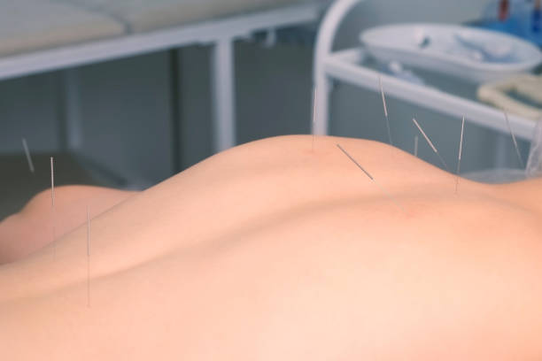 istock Acupuncture treatment with needles inserted to woman's back, closeup view. 1369573437