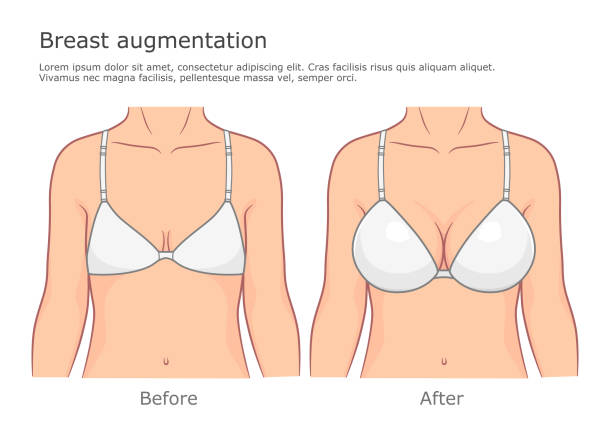 illustrazioni stock, clip art, cartoni animati e icone di tendenza di aumento del seno prima e dopo - cleavage