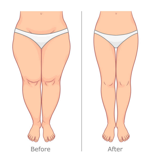 Legs fat loss illustration Woman legs weight loss vector illustration. Before and after. diet pills stock illustrations