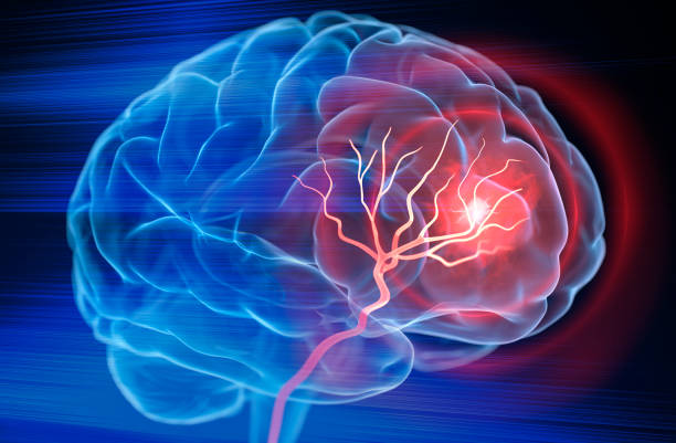cerebro accidente cerebrovascular - stroke fotografías e imágenes de stock