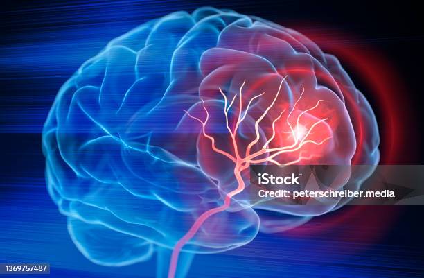 Brain Stroke Stock Photo - Download Image Now - Stroke - Illness, Human Brain, Healthcare And Medicine