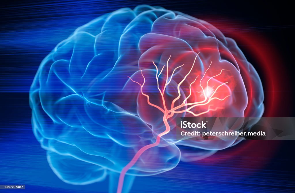 Brain stroke - Royalty-free İnme Stok görsel