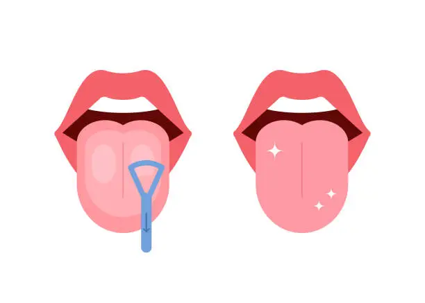 Vector illustration of Clean tongue throat cleaner scraper in mouth. Before and after tongue cleaning. Halitosis prevention. Vector illustration