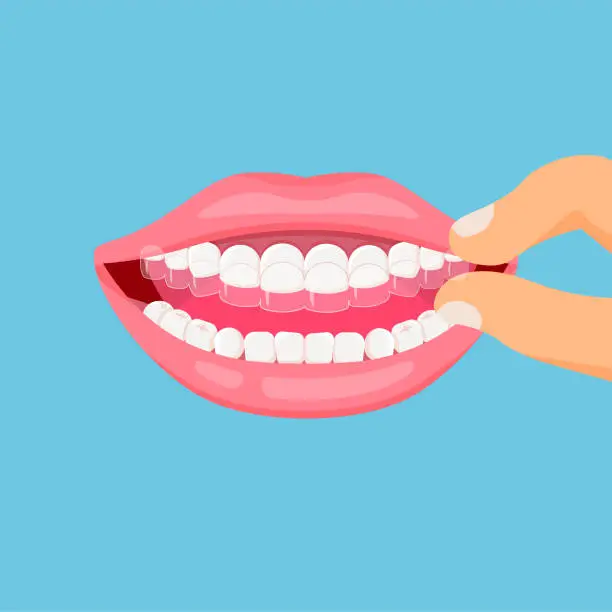 Vector illustration of Teeth with transparent braces.