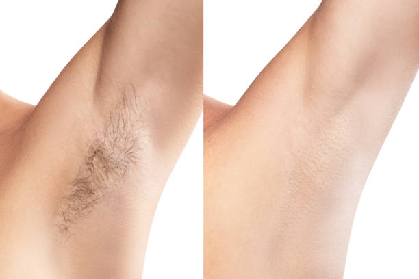 Comparison of female armpit after hair removal stock photo