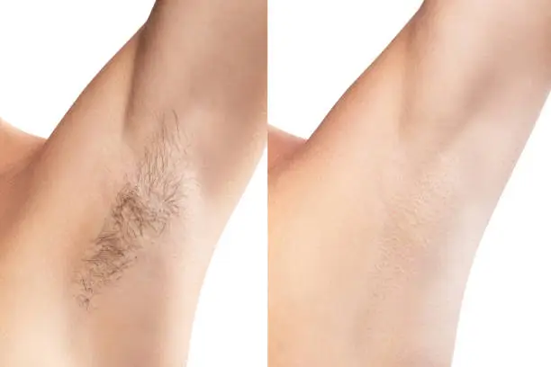 Comparison of female armpit after hair removal treatment