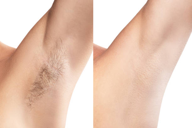 comparison of female armpit after hair removal - waxing armpit women beauty treatment imagens e fotografias de stock