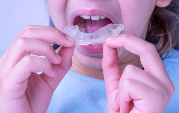 CAUCASIAN GIRL PLACING AN OCCLUSAL SPLINT. HEALTH AND CARE OF THE MOUTH. THERAPY FOR DISCOMFORT AND PAIN IN THE JAW. DENTAL TREATMENT CONCEPT. CLOSE UP. CAUCASIAN GIRL PLACING AN OCCLUSAL SPLINT. HEALTH AND CARE OF THE MOUTH. THERAPY FOR DISCOMFORT AND PAIN IN THE JAW. DENTAL TREATMENT CONCEPT. CLOSE UP. clenching teeth stock pictures, royalty-free photos & images