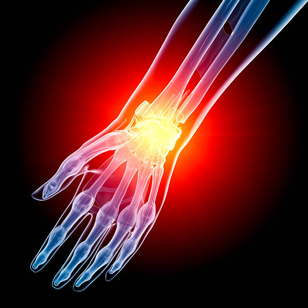 Wrist in pain x-ray stock photo