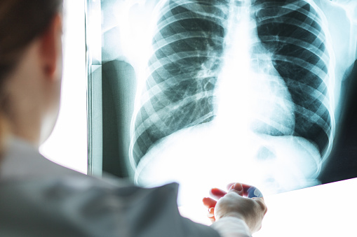 x-ray, bronchitis check, doctor with lung picture in medical clinic