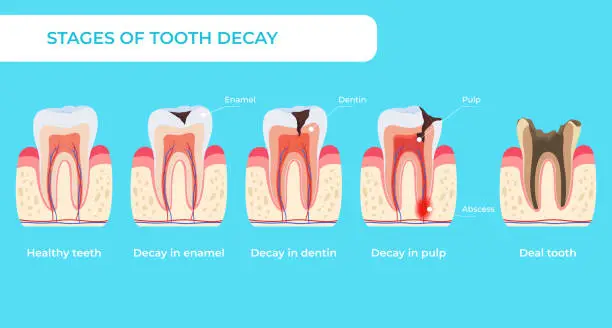 Vector illustration of Stage tooth decay infographic medical educational scheme names diagnosis vector flat illustration