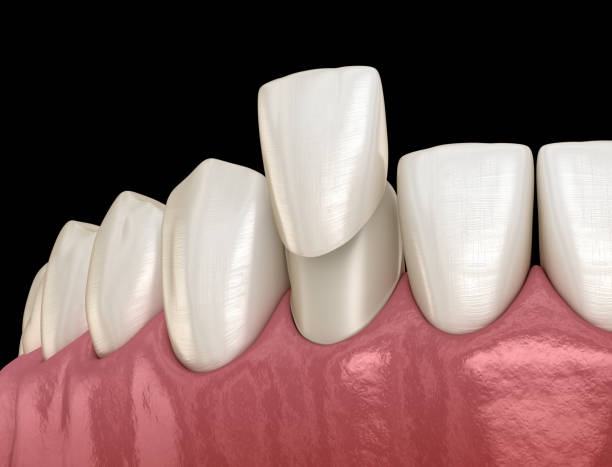 istock Veneer placement procedure. Medically accurate tooth 3D illustration 1370426588