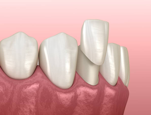 istock Veneer placement procedure. Medically accurate tooth 3D illustration 1370426590