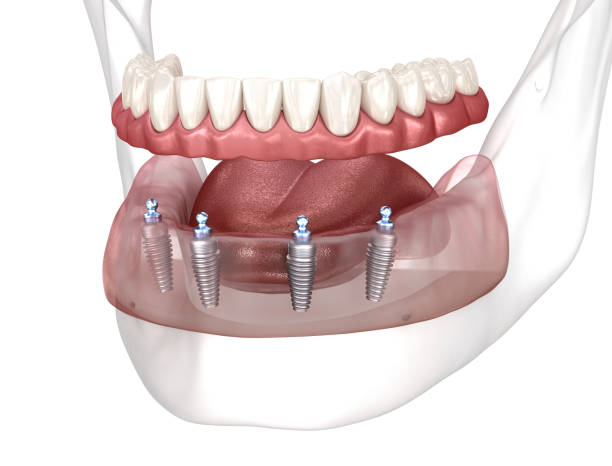 removable mandibular prosthesis all on 4 system supported by implants. medically accurate 3d illustration of human teeth and dentures concept - implantat imagens e fotografias de stock