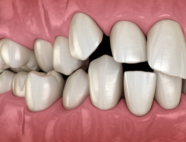 überfüllte zähne, abnorme zahnverschlüsse. medizinisch genaue zahn-3d-illustration - fehlbiss stock-fotos und bilder