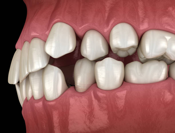 istock Overcrowded teeth, abnormal dental occlusion. Medically accurate tooth 3D illustration 1370426622