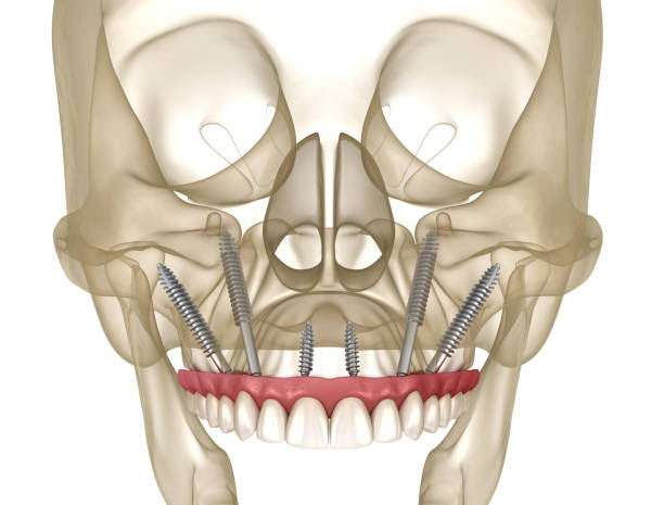 maxillary prosthesis supported by zygomatic implants. medically accurate 3d illustration of human teeth and dentures - implantat imagens e fotografias de stock