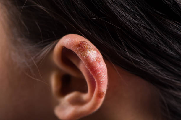 close up of child ear with chilblain - congelação imagens e fotografias de stock