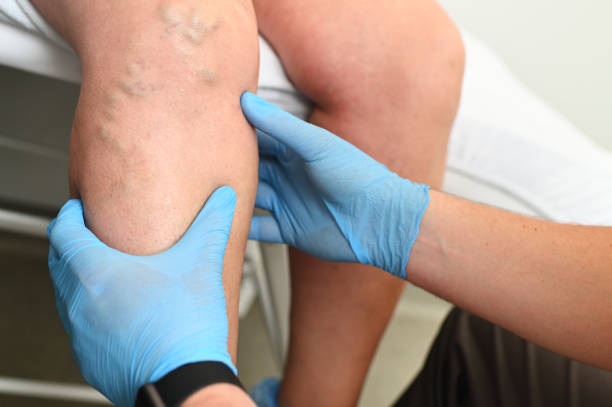 hlebologist examine un patient avec des varices sur la jambe - thrombose photos et images de collection