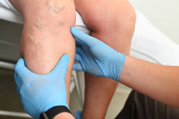 hlebologist examines a patient with varicose veins on his leg - coágulo imagens e fotografias de stock